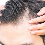 Best Hair Loss Treatments