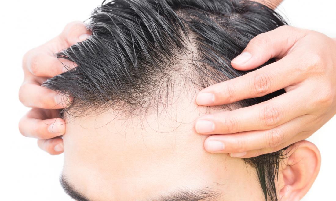 Best Hair Loss Treatments